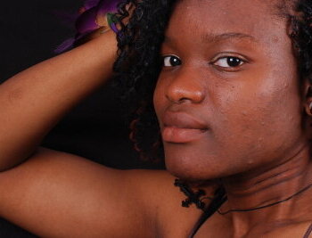 Ingredientes naturais para combater a acne